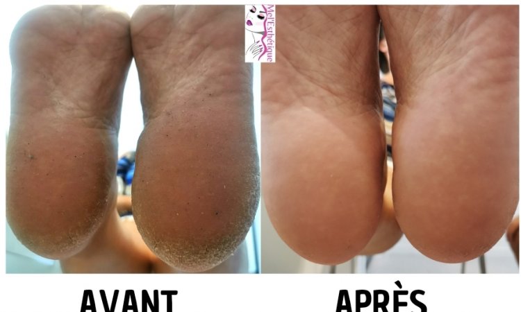 Promotion calluspeeling (soin anti callosité des pieds) à Vienne
